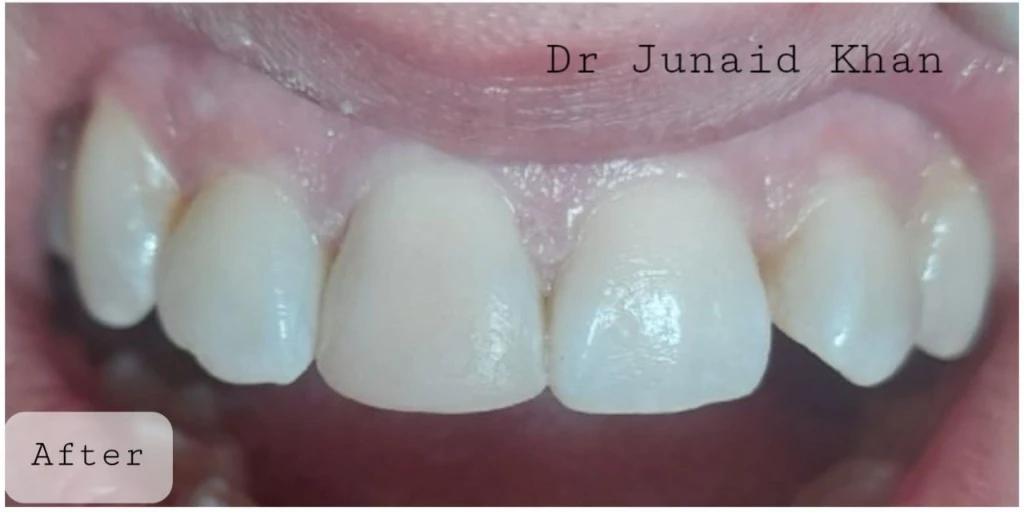 Chipped Incisor & Gum Line Aesthetic Makeover — After treatment