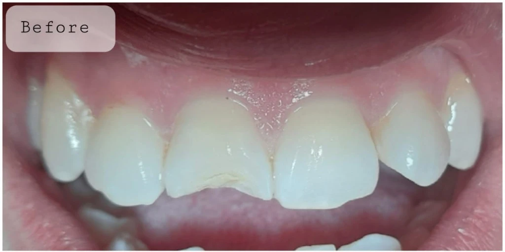 Chipped Incisor & Gum Line Aesthetic Makeover — Before treatment